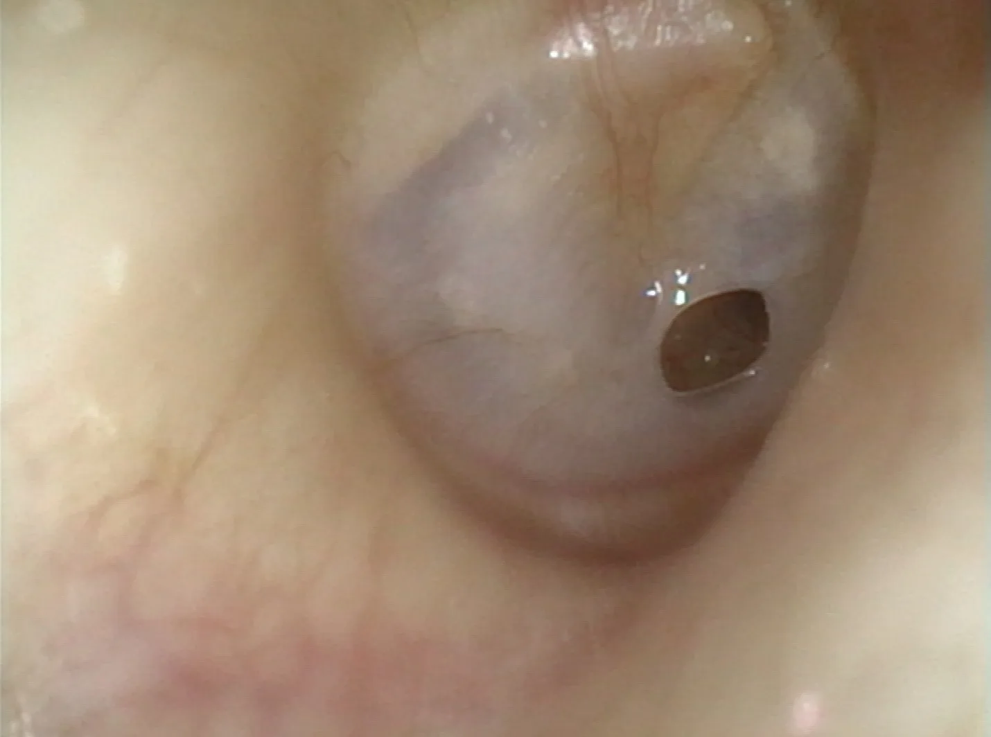 Perforation of the tympanic membrane (eardrum), otoscopic view