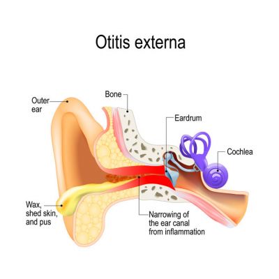 Swimmer's ear (otitis externa): inflamed ear canal