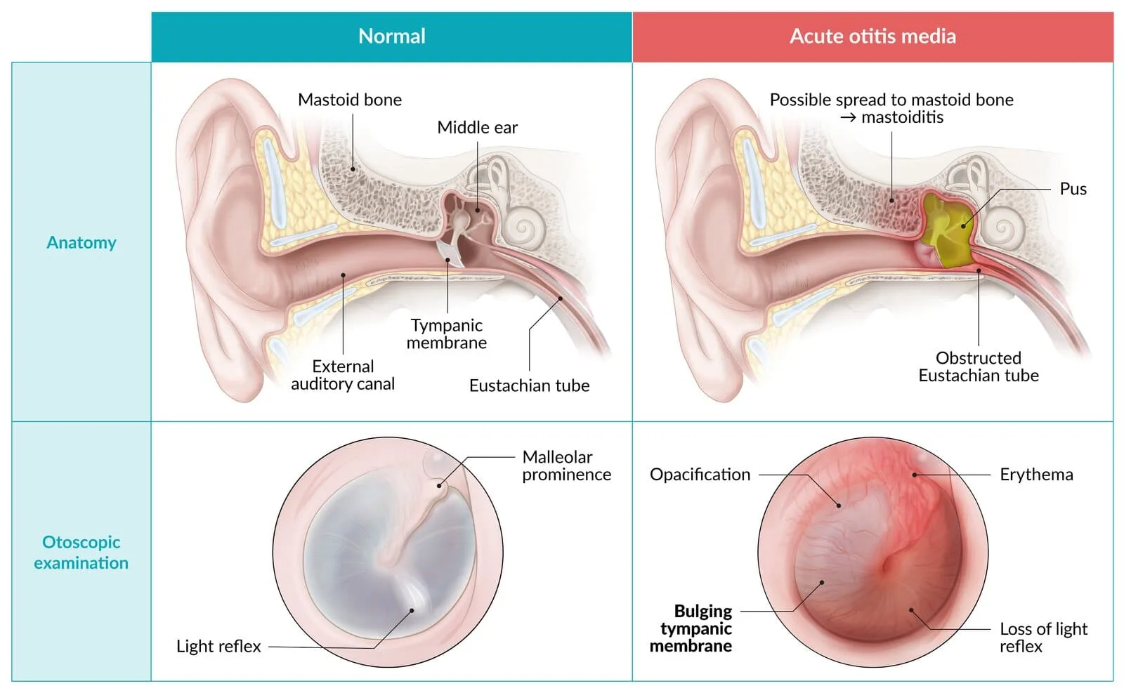 Acute otitis media: middle ear infection in children