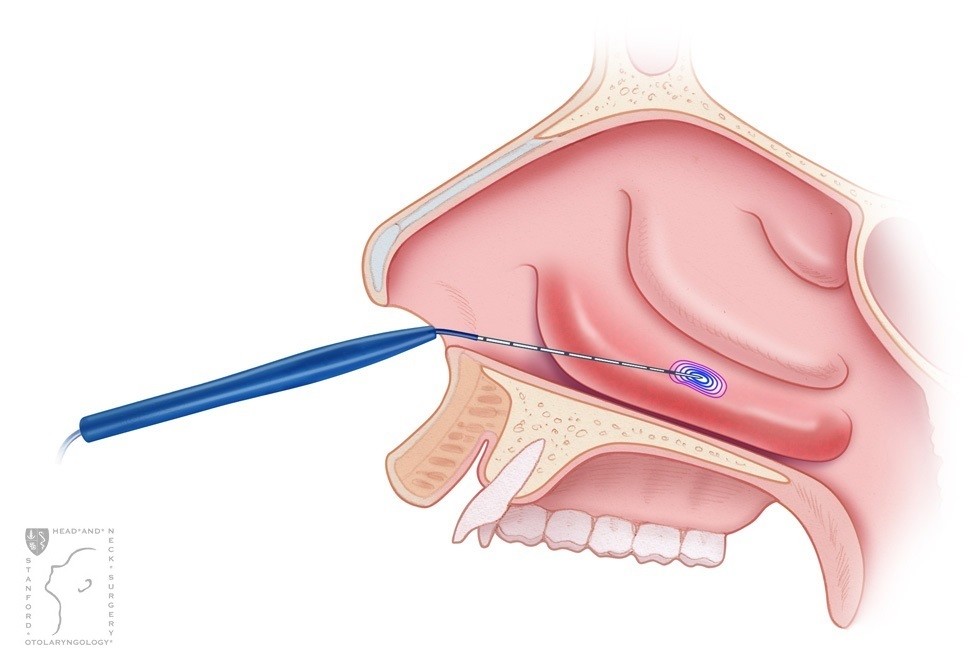 Radiofrequency instrument during nasal turbinate reduction